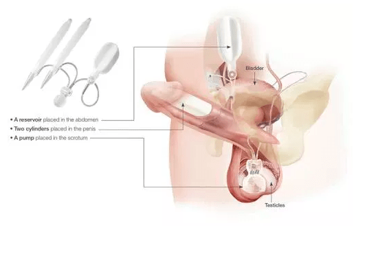 christian henrich recommends penile implant porn pic