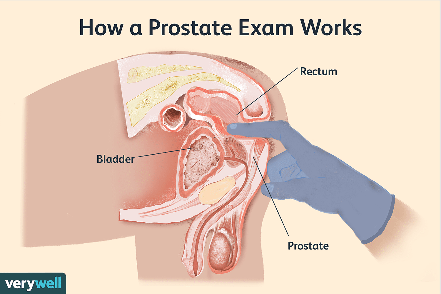 bruce morningstar recommends prostate milking story pic