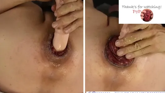 andie campbell recommends anal prolapse fuck pic