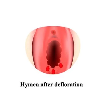 bj salinas recommends defloration of the hymen pic